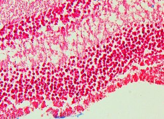 The role of iron in blindness caused by ocular toxoplasmosis