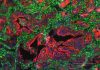 Researchers identify protein linked to metastasis in pancreatic cancer