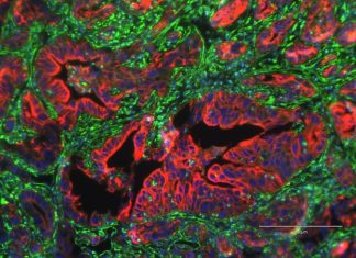 Researchers identify protein linked to metastasis in pancreatic cancer