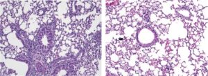 Allergic Asthma Could Be Calmed by Flipping Immune Cell Switch