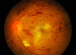 Exonate first-in-class eye drop Phase Ib/IIa trial data demonstrate safety and biological activity in treatment of diabetic retinopathy and diabetic macular oedema