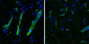 snRNA-seq Reveals Remarkable Cellular and Molecular Overlap between ALS and FTLD