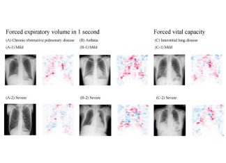 Innovative, highly accurate AI model can estimate lung function just by using chest x-rays