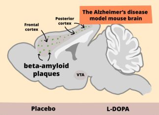 Alzheimer’s Disease Symptoms Lessened and Improved in Mice by Dopamine Treatment
