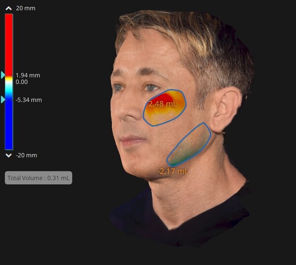 Experts Agree On the Longevity of EMFACE’s Non-Invasive Face-Lifting Effects