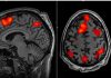 New normative neuroimaging library sets standard for brain injury research