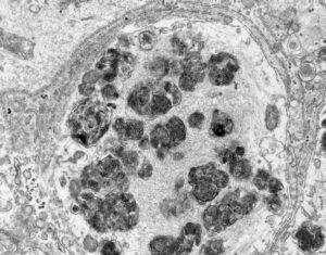 Parkinson’s Lewy Bodies Formed in Human Neuronal Stem Cells