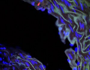 Progeria’s Cardiovascular Complications Could Be Treated with New Protein Finding