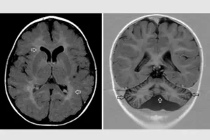 Child with Rare, Genetic, Neurological Disease Receives Diagnosis, With C. elegans’ Help