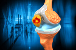 Mutation Mechanism Found That Drives the Aggressive Development and Evolution of Osteosarcoma
