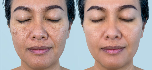The Australian Photoageing Re.Port uncovers Australia’s blind spot-on sun damage and skin health, taking unexpected emotional toll