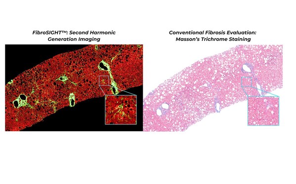 A New Standard in Clinical Care for MASH Patients: HistoIndex Launches FibroSIGHT™