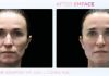 BTL’s EMFACE Surpasses 1 Million Treatments, Becoming the Fastest-Growing Non-Invasive Facial Lifting Procedure