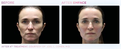 BTL’s EMFACE Surpasses 1 Million Treatments, Becoming the Fastest-Growing Non-Invasive Facial Lifting Procedure