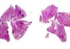 Uncovering Aspirin’s Mechanism to Reduce Cancer Metastasis in Mice