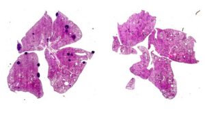 Uncovering Aspirin’s Mechanism to Reduce Cancer Metastasis in Mice