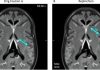 UNM Researchers Uncover Mechanism of Toxic Metal Nanoparticles from MRI Scans Penetrating Human Tissue