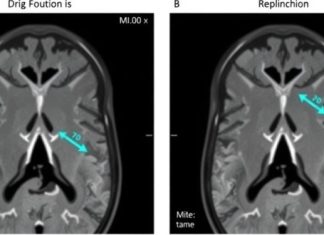 UNM Researchers Uncover Mechanism of Toxic Metal Nanoparticles from MRI Scans Penetrating Human Tissue