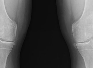 Genetic Links for Common Inflammatory Arthritis Open Treatment Options