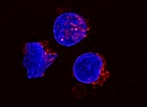 Immune Response in Advanced Ovarian Cancer Weakened by Phospholipids in Ascites