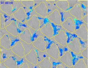 Biofilm Formation by Microbial Pathogens Inhibited by Patterns on Medical Device Plastics