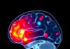 Vigabatrin-Linked Brain MRI Changes in Epileptic Kids