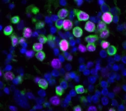 Common Respiratory Viral Infections Awaken Dormant Breast Cancer Cells in Lungs