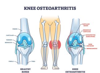 FDA Grants Regenerative Medicine Advanced Therapy Designation to Gene Therapy for Osteoarthritis