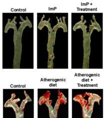 Gut Microbiota Metabolite Could Point to Atherosclerosis Diagnostics, Therapeutics