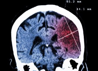 Prime editing reverses symptoms of severe childhood neurological disease