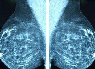 Artificial intelligence set to transform mental health care for breast cancer patients
