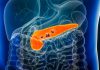 Breaking the Link Between Alcohol Use and Pancreatic Cancer