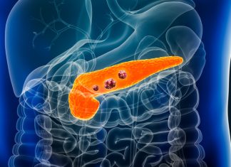 Breaking the Link Between Alcohol Use and Pancreatic Cancer
