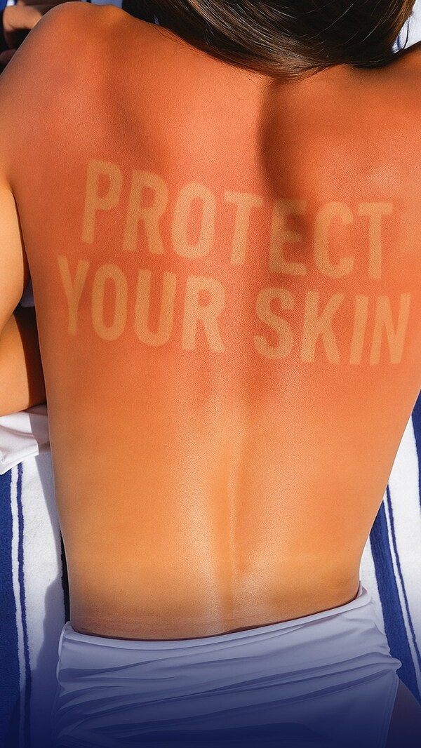 LA ROCHE-POSAY AND GLOBAL SKIN HEALTH EXPERTS UNITE TO WARN ABOUT LONG TERM CONSEQUENCES OF DANGEROUS ‘BURN LINES’ SOCIAL MEDIA TREND