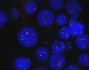 Mantle Cell Lymphoma Translocations Rewire Chromosome-Wide Gene Expression