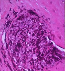 Kinase Inhibitor Shows Promise in Children with Ewing Sarcoma