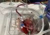 In a First, Scalable Production of Human Kidney Organoids Using Perfused Pig Kidneys