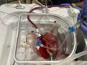 In a First, Scalable Production of Human Kidney Organoids Using Perfused Pig Kidneys