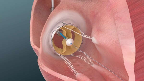 Trisol Medical Announces Positive Results from U.S. Early Feasibility Study of Its Transcatheter Tricuspid Valve Replacement System