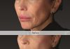 Global Aesthetic Trends Evolve Toward ‘Anti-Sagging’: The Expansion of the Structural Skin Laxity Improvement and Liquid Type PCL Collagen Stimulator Market