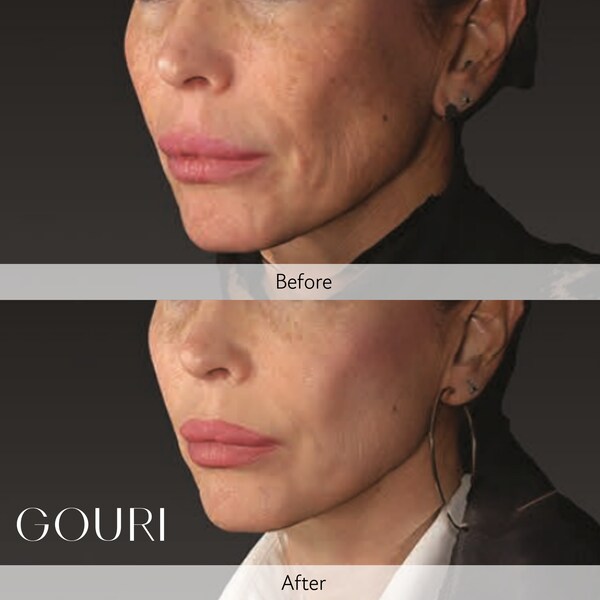 Global Aesthetic Trends Evolve Toward ‘Anti-Sagging’: The Expansion of the Structural Skin Laxity Improvement and Liquid Type PCL Collagen Stimulator Market