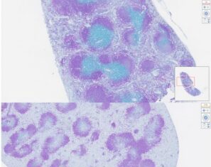 Nanoparticles Trigger In Vivo CAR T Cell Generation to Eliminate B Cells