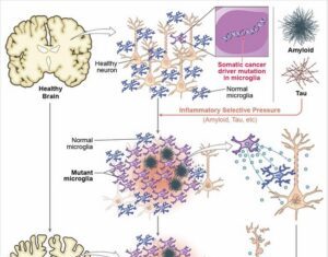 Alzheimer’s Linked to Cancer Mutations in Brain Immune Cells