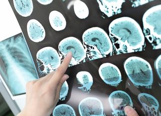 Collaboration advances EMA601 as potential first-in-class stroke therapy