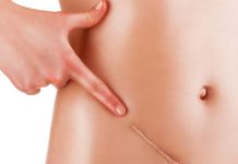 Implantable cytokine factories show promise against advanced ovarian cancer