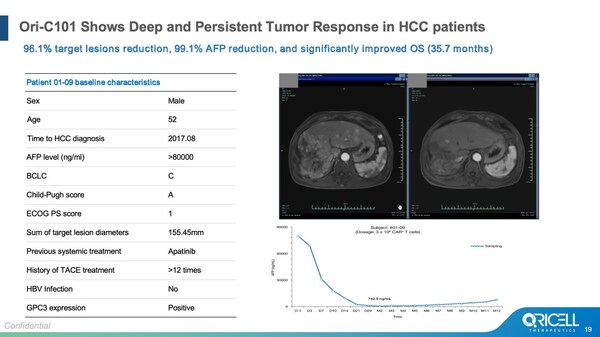 ASCO 2026 | Oricell’s GPC3 CAR-T Ori-C101 Hits 66.7% ORR in Late-Line HCC, Signaling Best-in-Class Potential