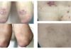 Vitamin Derivative Pantethine Alleviates Psoriasis Symptoms in Small Human Trial