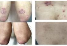 Vitamin Derivative Pantethine Alleviates Psoriasis Symptoms in Small Human Trial